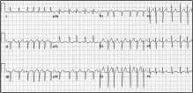 Electrocardiographic manifestations of COVID-19