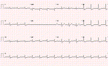 The importance of lead aVR interpretation by emergency physicians