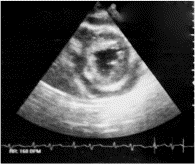 Fatal cardiac tamponade as the first manifestation of acute myeloid leukemia