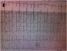 Spontaneous intramedullary hematoma initially mimicking myocardial infarction