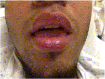 Technology advancements in the diagnosis and treatment of peritonsillar abscess