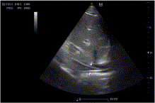 An atypical misplacement of a temporary pacing catheter diagnosed and resolved by ultrasound