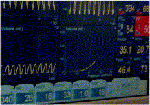 Is abdomen release really necessary for prone ventilation in acute respiratory distress syndrome?