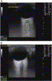 The role of bedside ultrasound in pretherapeutic and posttherapeutic lumbar puncture in patient with idiopathic intracranial hypertension