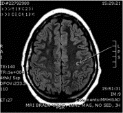 Diagnosing frontal lobe epilepsy in the ED