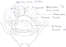 Obstetrical catastrophe averted: successful outcome of an abdominal pregnancy