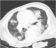 Endogenous Klebsiella pneumoniae endophthalmitis