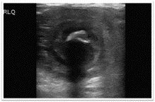 Ileocolic intussusception secondary to gastrointestinal stromal tumor in a 61-year-old