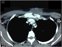Tuberculous sternal osteomyelitis