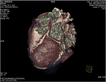 Coronary aneurysms in patients with systemic lupus erythematosus