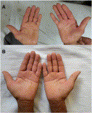 Purple glove syndrome occurring after oral administration of phenytoin in therapeutic doses: mechanism still a dilemma