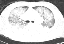 Acute respiratory distress attributed to sirolimus in solid organ transplant recipients