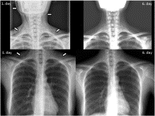 Occurrence of pneumomediastinum due to dental procedures