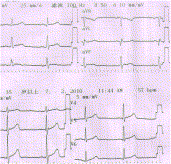 The spontaneous pneumopyopericardium simultaneously masquerading as acute myocardial infarction and surgical abdomen: a case report