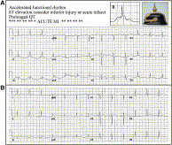 Emergence and resolution of the electrocardiographic spiked helmet sign in acute noncardiac conditions