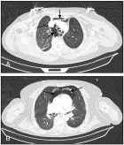 Tracheal laceration as a complication of out-of-hospital emergency tracheal intubation in a patient with COPD