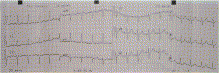 Could contrast-enhanced CT detect STEMI prior to electrocardiogram?