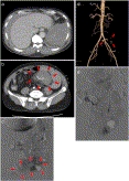The intractable intra-abdominal hemorrhage with unknown etiology in a patient with severe hemophilia A