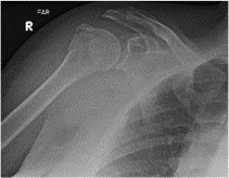 Novel use of ultrasound in the ED: ultrasound-guided hematoma block of a proximal humeral fracture