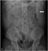 Spontaneous rupture of intercostal artery after severe cough