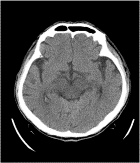 Hypertensive brain stem encephalopathy