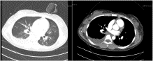 Successful resuscitation with thrombolysis of pulmonary embolism due to thrombotic thrombocytopenic purpura during cardiac arrest