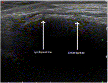 Evaluation of the effectiveness of bedside point-of-care ultrasound in the diagnosis and management of distal radius fractures