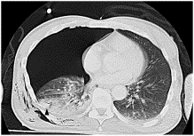 Chest tube insertion direction: is it always necessary to insert a chest tube posteriorly in primary trauma care?